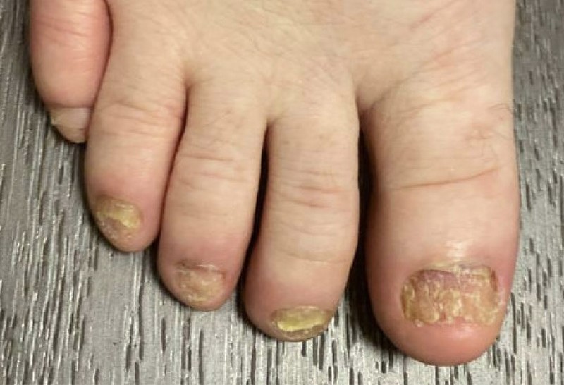 Nagelpilz Großzeh vor Nd:YAG Lasertherapie in Jena