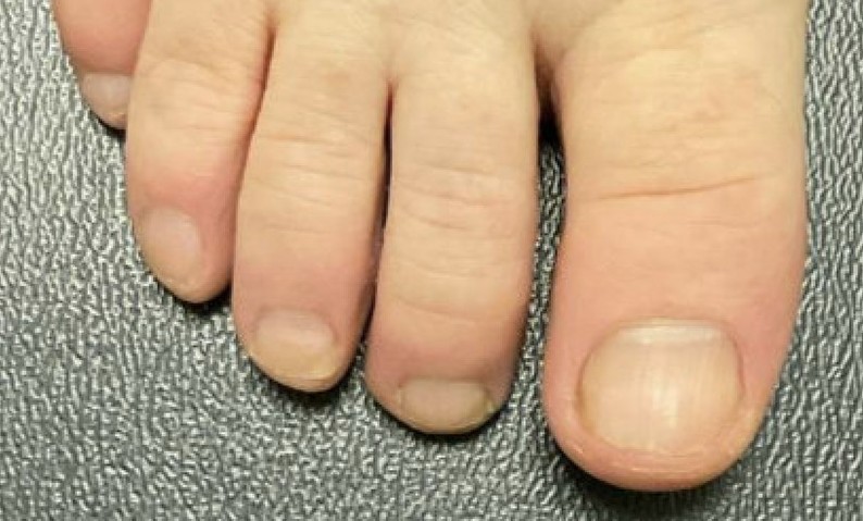 Großzeh nach mehreren Nd:YAG Lasersitzungen in Jena