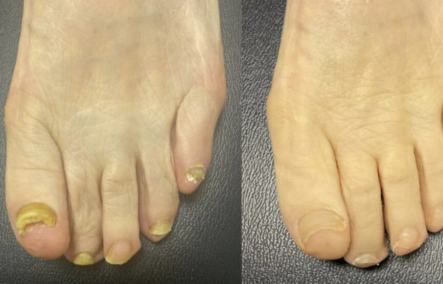 Dokumentierter Verlauf Nagelpilz Lasertherapie Podologie Jena